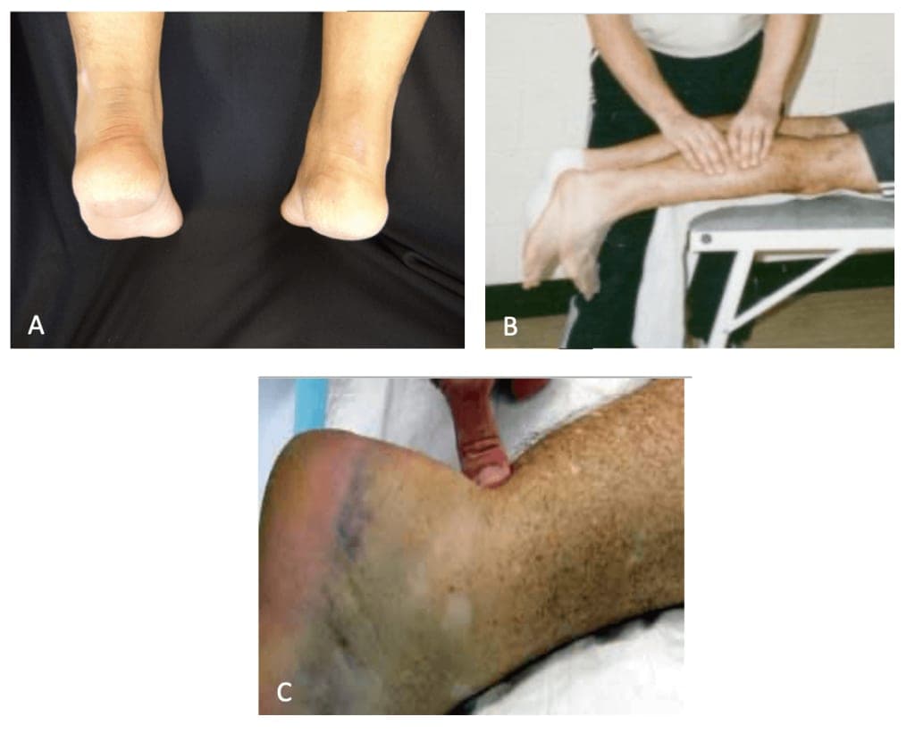 achille's tendon rupture sf studios london