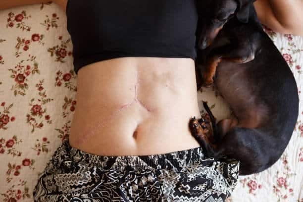 woman leaning dow showing her liver transplant scars .