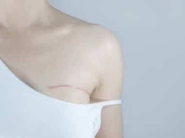scar treatments 4 sf studios london