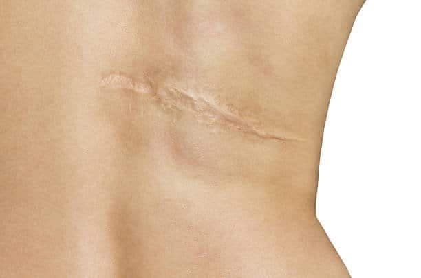 scar after operation on back of women on white background